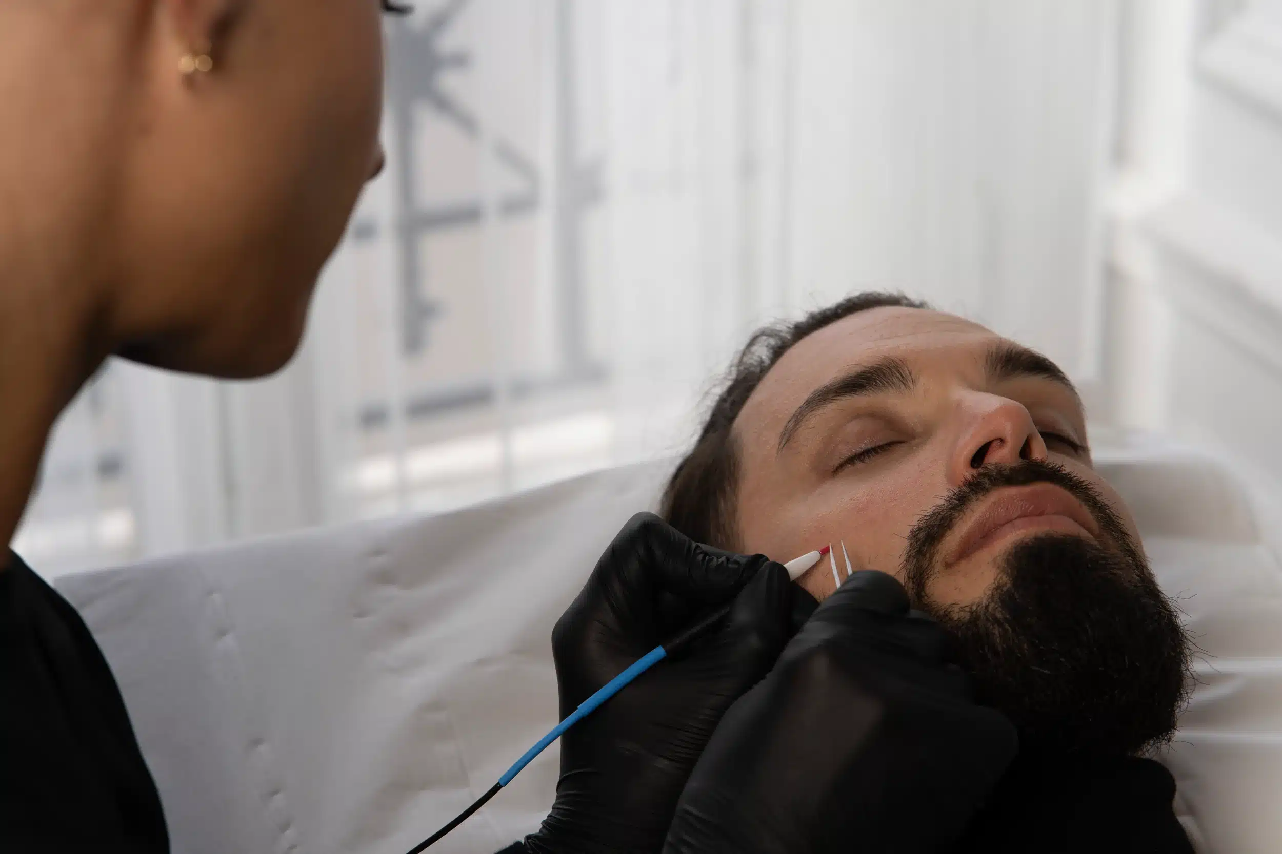 L'épilation électrolyse pour homme : la seule technique véritablement définitive
