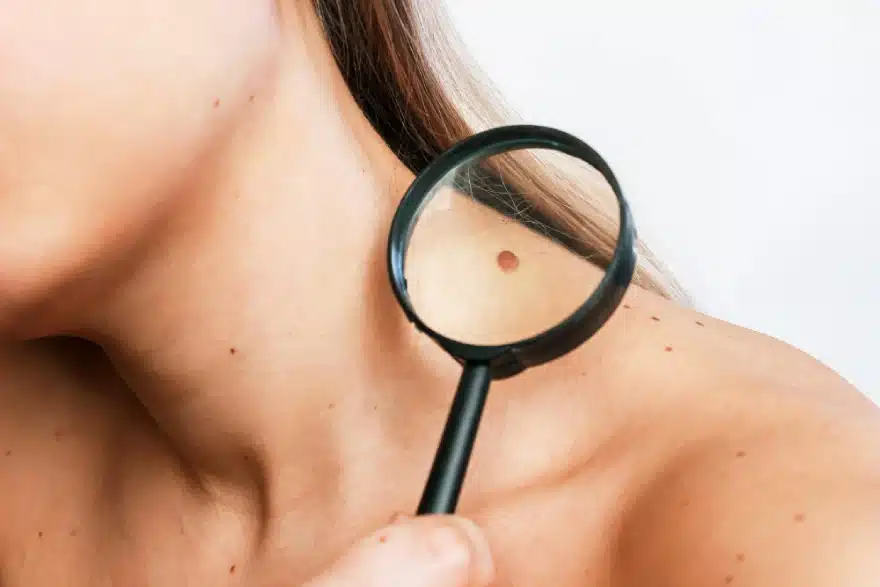 Épilation laser et grain de beauté : peut-on traiter sans risque ?