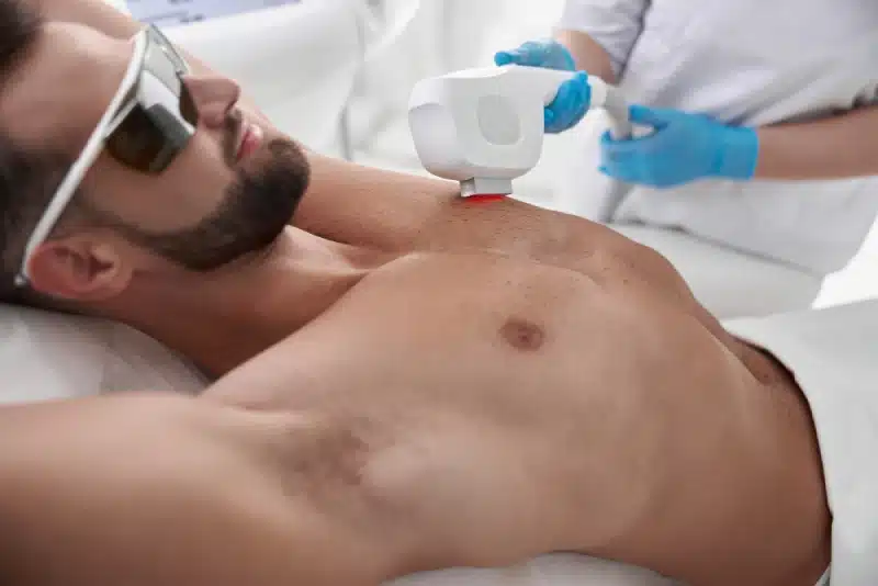 Torse net et sans poils : focus sur l'épilation du torse homme au laser