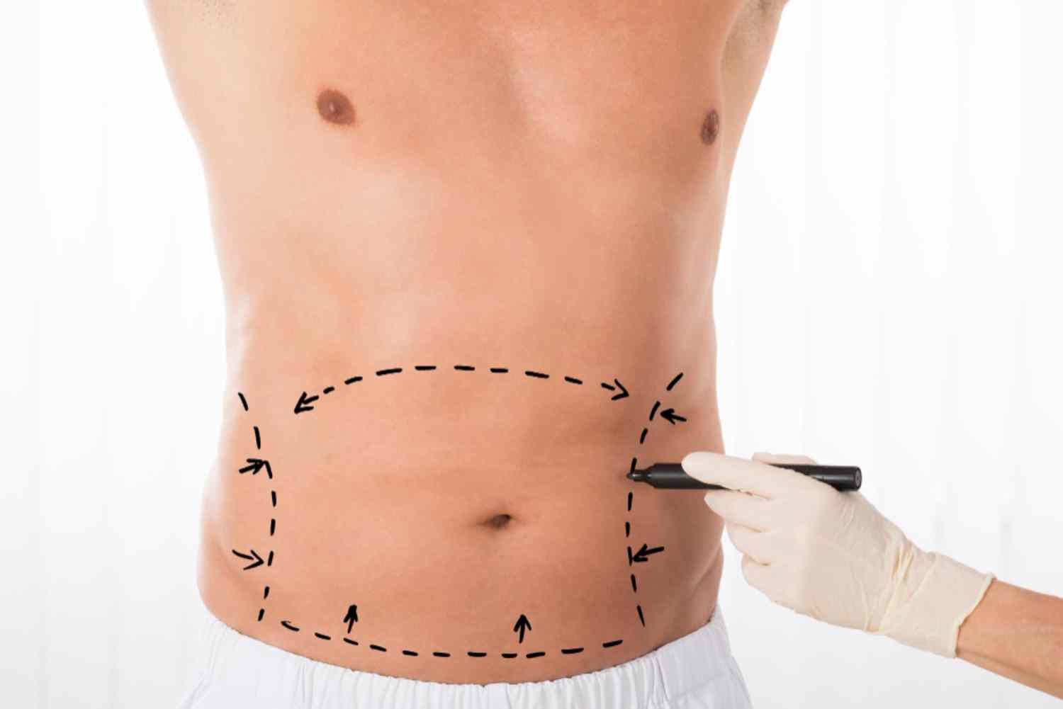 Votre bilan silhouette offert : indispensable pour votre projet de cryolipolyse
