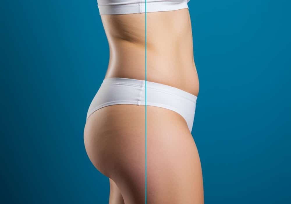 Avant/après : l'effet de la cryolipolyse sur la cellulite