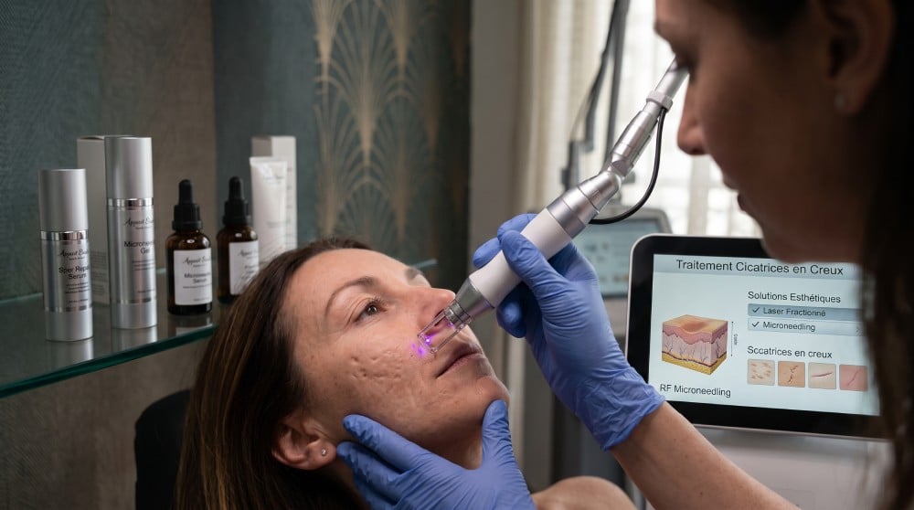 Cicatrices en creux : solutions esthétiques pour les atténuer efficacement