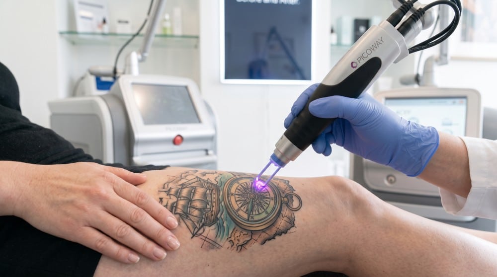 Détatouage au laser : tout ce qu'il faut savoir avant de faire effacer un tatouage